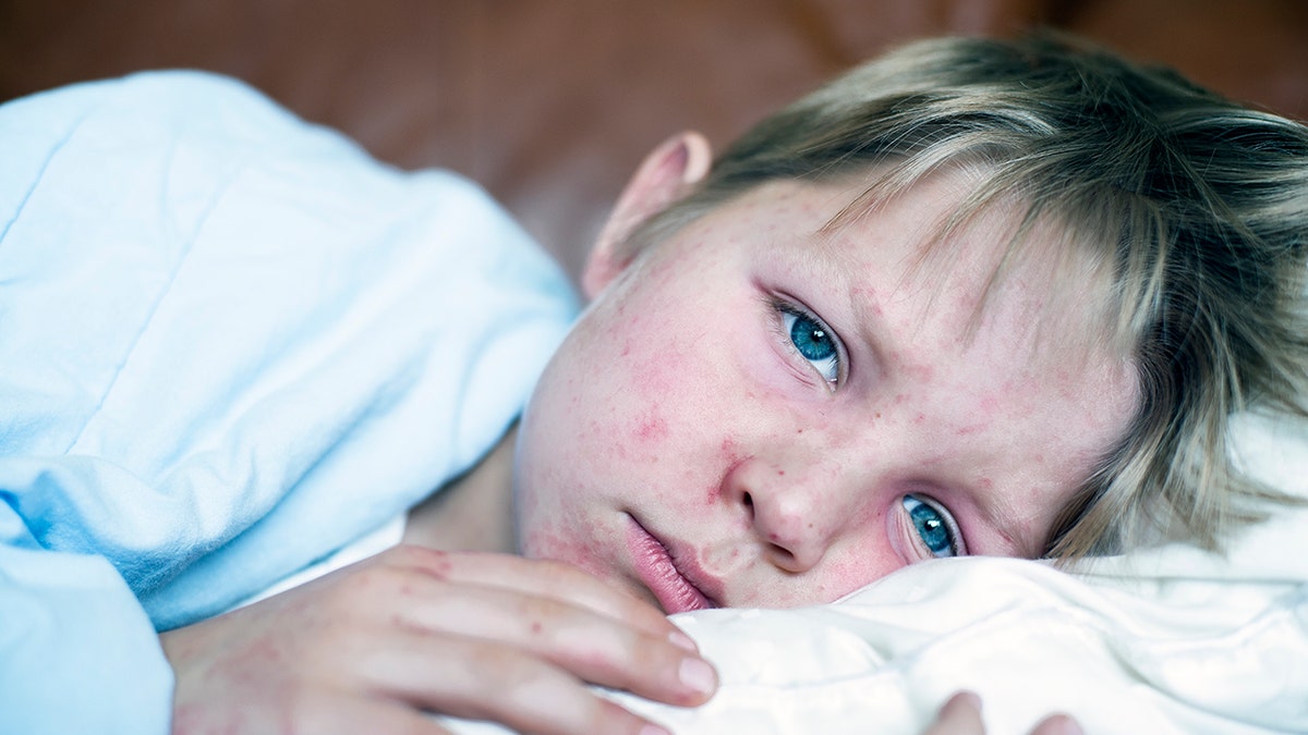 measles, Texas, outbreak, cases, symptoms, DSHS, vaccination, MMR, rubella, mumps, South Plains, spread, contagious, airborne