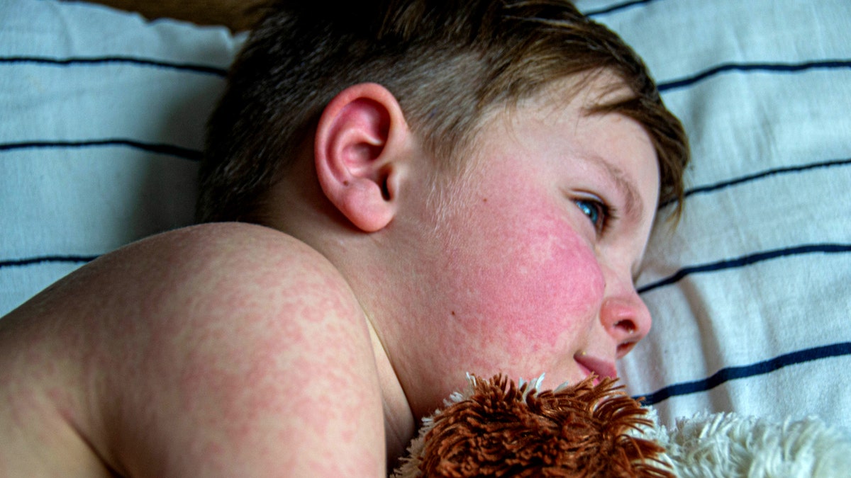 measles outbreak, Texas, New Mexico, measles death, vaccination, MMR vaccine, unvaccinated, herd immunity, school-aged children, Texas Department of State Health Services, DSHS, Marc Siegel, Fox News, Covenant Children's Hospital, Lubbock, pneumonia, health news
