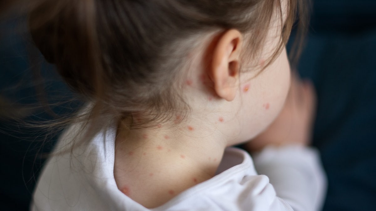 measles outbreak, measles death, West Texas, Gaines County, Lubbock, Texas Department of State Health Services, DSHS, New Mexico Department of Health, NMDOH, Lea County, New Jersey Department of Health, NJDOH, MMR vaccine, vaccination, unvaccinated, Dr. Marc Siegel, childhood vaccines, herd immunity, pneumonia, Fox News
