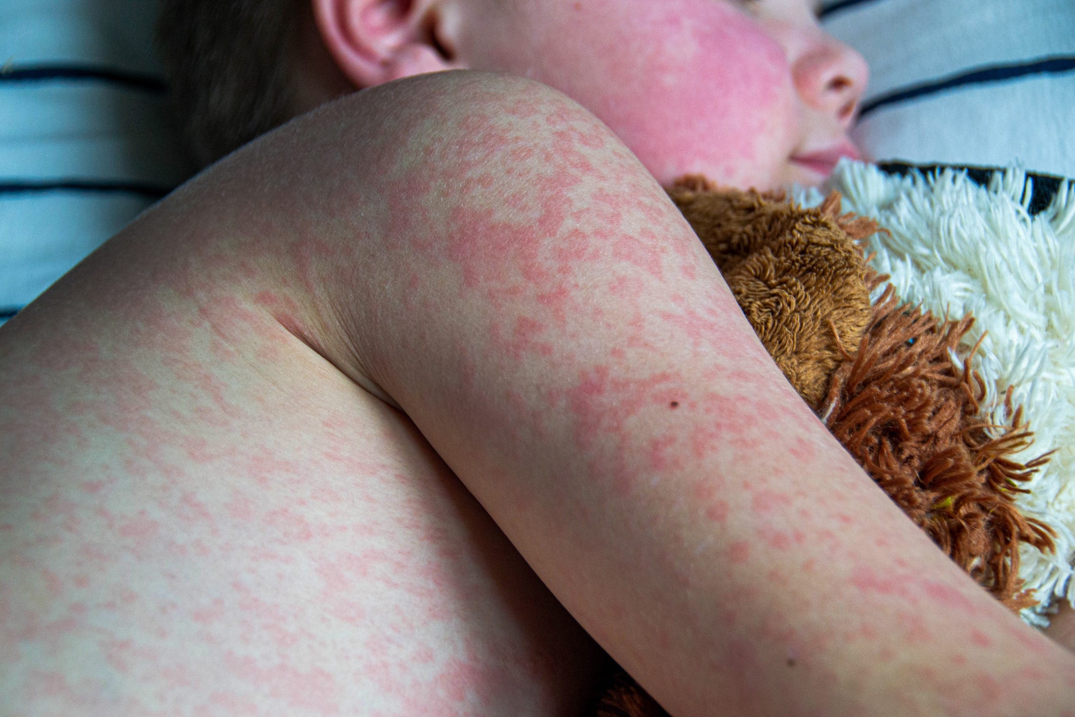 measles, vaccination, public health, vaccine hesitancy, Robert F. Kennedy Jr., MMR vaccine, infectious disease, outbreaks, Texas, child death, preventable disease, scientific consensus, evidence-based medicine, politicization of health, distrust in science, COVID-19 vaccines, ivermectin, misinformation, vaccine safety, autism, herd immunity, children's health, vaccine conspiracy, Stanford University School of Medicine, Dr. Thomas K. Lew
