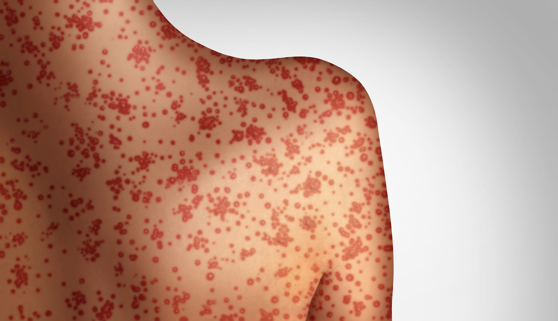 measles, outbreak, cases, Oklahoma, Vermont, Texas, New Mexico, CDC, vaccination, symptoms, contagious, health, children, virus, fever, rash, travel, unvaccinated, infection, prevention
