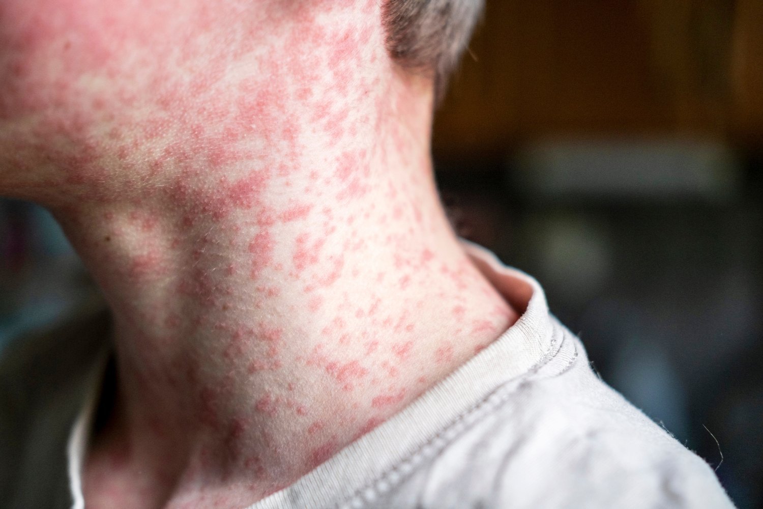 measles outbreak, Texas, New Mexico, CDC, vaccination, Robert F. Kennedy Jr., MMR vaccine, public health, health advisory, infectious disease, preventable disease, herd immunity
