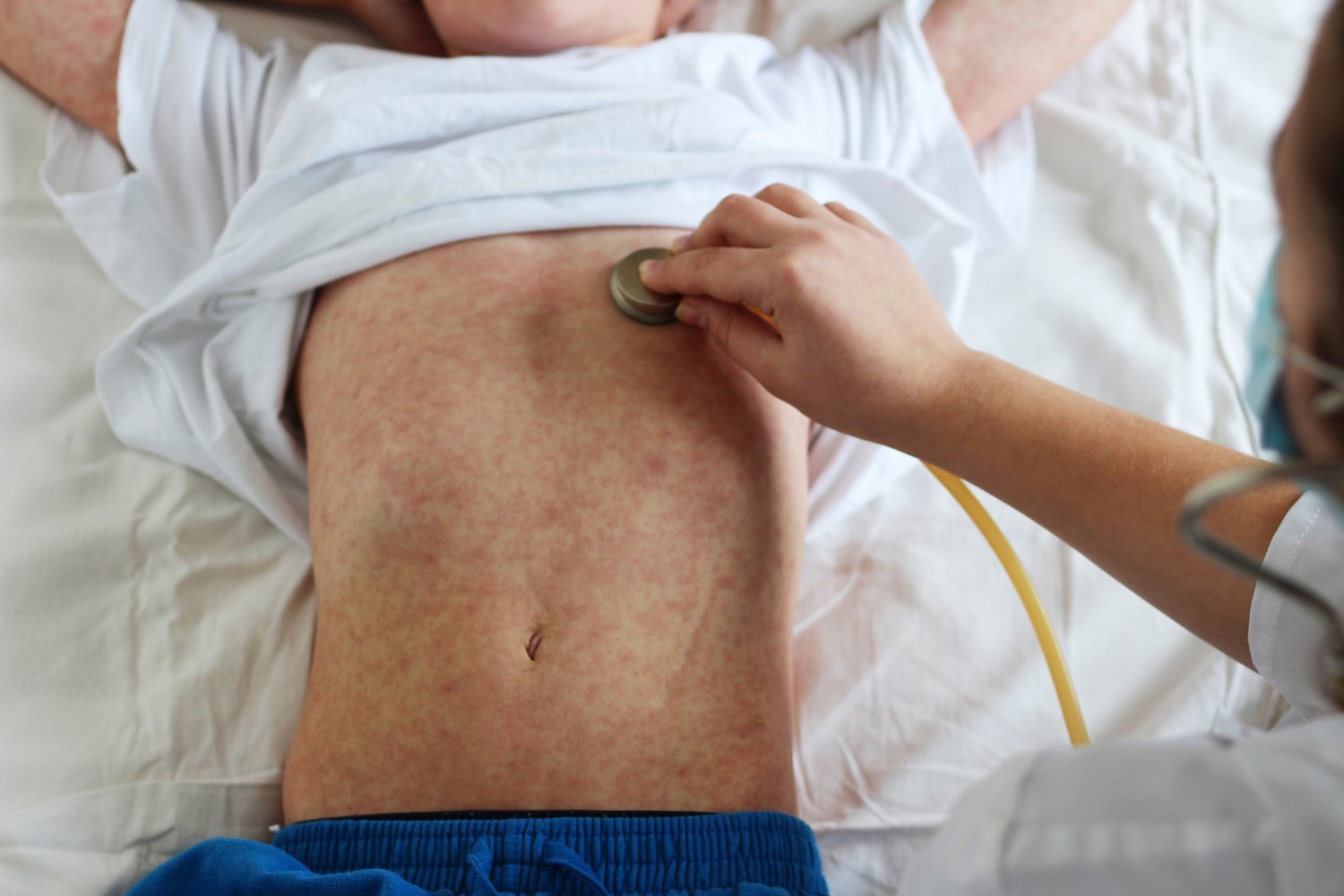 measles, measles outbreak, measles cases, measles vaccine, measles Europe, measles United States, WHO, UNICEF, vaccination rates, herd immunity, MMR vaccine, infectious disease, public health, disease resurgence, vaccine preventable disease
