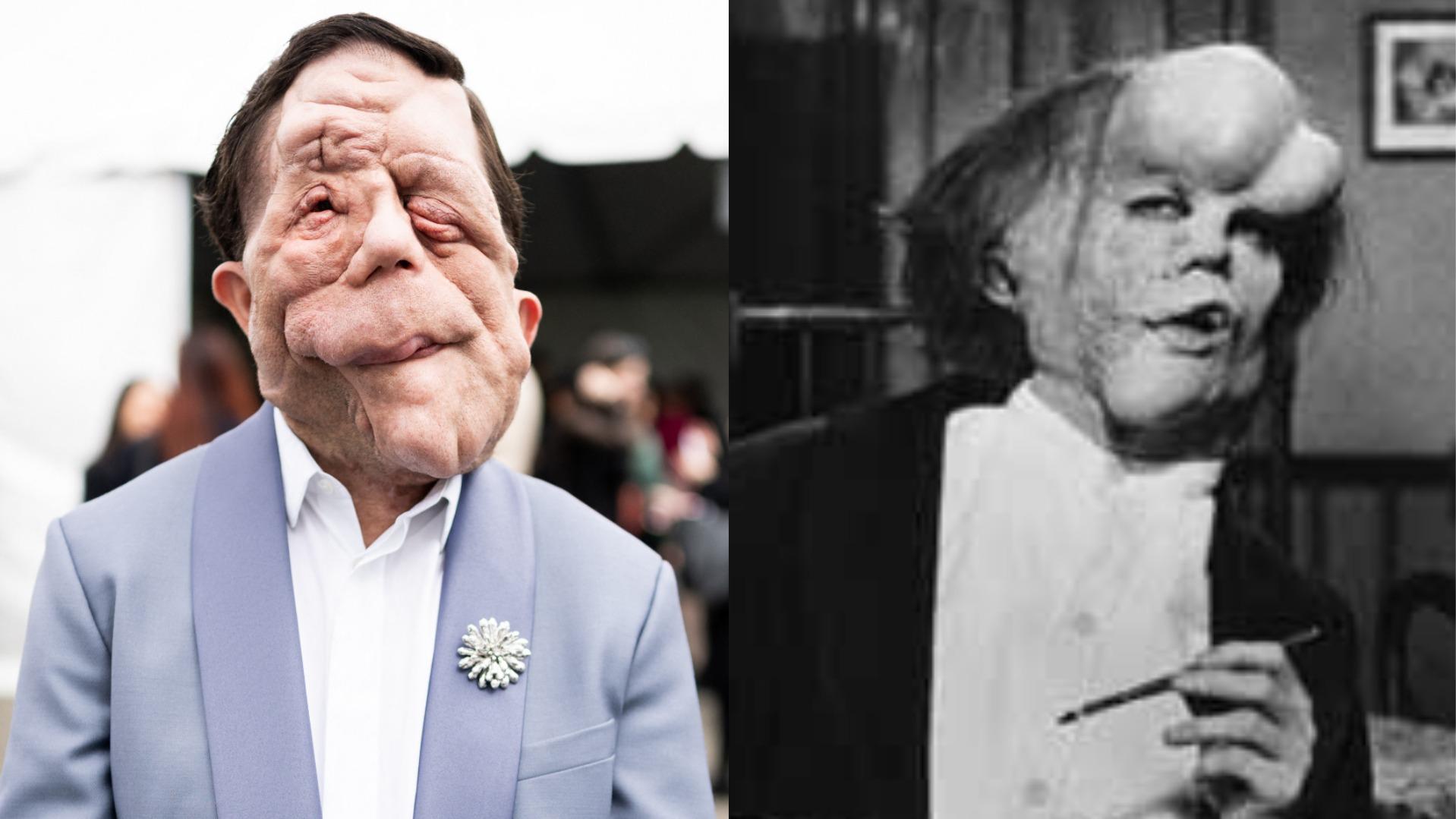 Adam Pearson, Elephant Man, Joseph Merrick, neurofibromatose, handicap, cinéma, film, adaptation, Bernard Pomerance, Jack Huston, John Hurt, David Lynch, A Different Man, Sebastian Stan, Eve Pomerance, Hollywood Reporter, tournage, 2026
