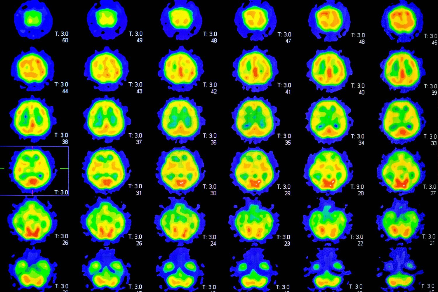 Alzheimer's, Alzheimer's risk, PET scan, amyloid beta, dementia, cognitive decline, mental health, healthy lifestyle, prevention, anxiety, depression, motivation, anti-amyloid drugs, early detection, brain health, memory concerns, research study
