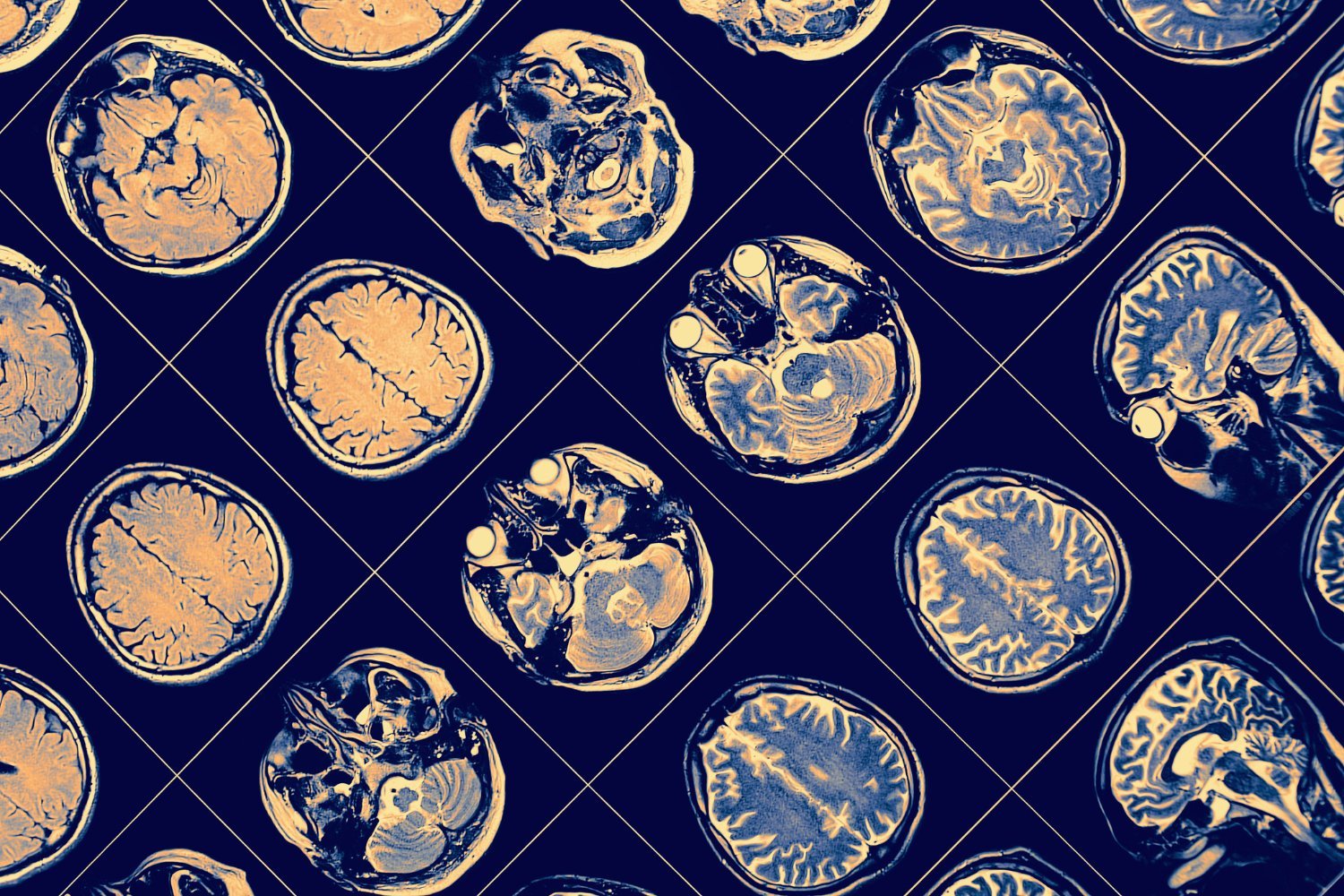 New Brunswick, brain disease, mystery illness, neurological syndrome of unknown cause, NSUC, cluster, Alier Marrero, JAMA Neurology, MIND Clinic, undiagnosed disease, environmental trigger, investigation, symptoms, dementia, hallucinations, Yves Léger

