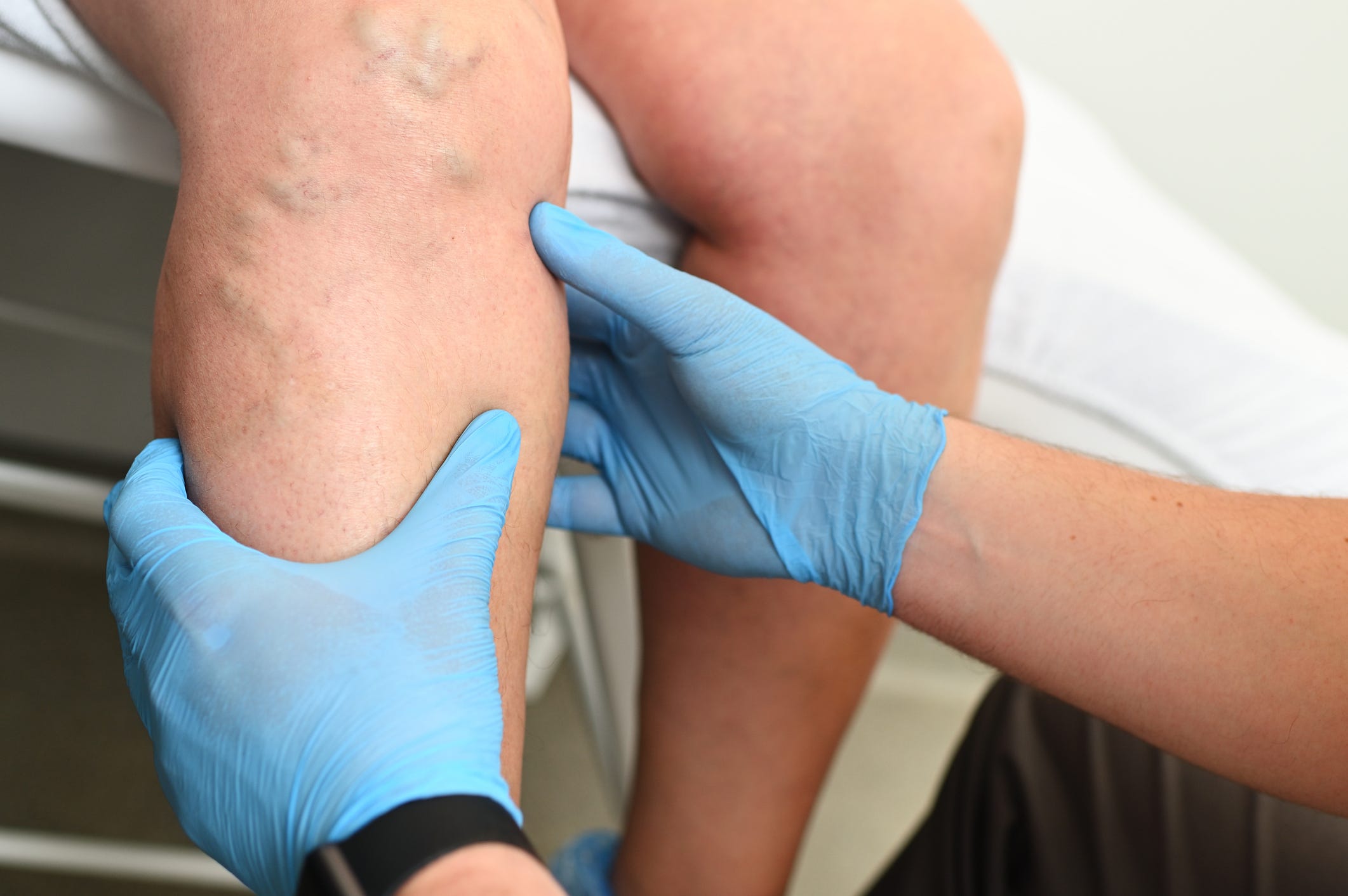 Blood clots, coagulation, thrombosis, embolism, deep vein thrombosis (DVT), pulmonary embolism, arterial embolism, stroke, heart attack, renal vein thrombosis, mesenteric ischemia, blood vessel damage, platelets, fibrin, hypercoagulability, risk factors, blood clot prevention, Dr. Shaline Rao, Dr. Fadi Elias Shamoun, Dr. Doris Chan
